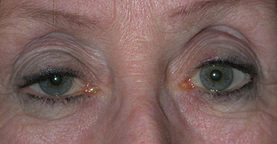 Older woman with ptosis, or droopy eyelid