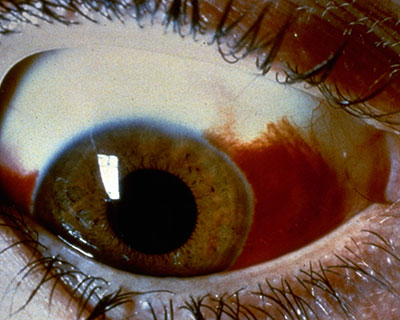 Photo of subconjunctival hemorrhage, when blood appears in the white of the eye from a broken blood vessel.