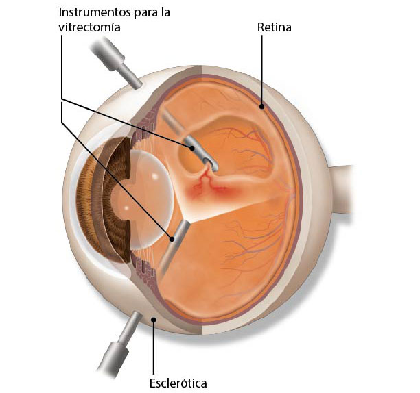 Vitrectomía. La vitrectomía es un tipo de cirugía ocular que se utiliza para tratar los problemas de la retina y el humor vítreo.